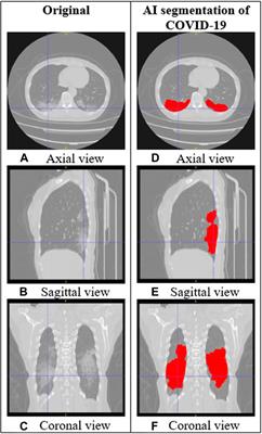 AI-Assisted CT as a Clinical and Research Tool for COVID-19